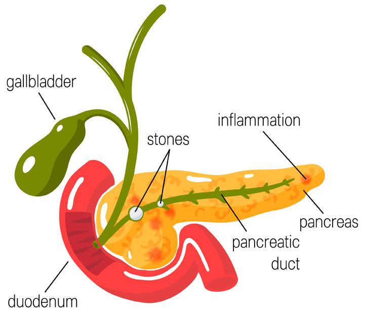 Medical illustration of inflamed pancreas in cross section, duodenum and gallbladder.